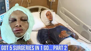 I GOT A FACELIFT IN MY 20’S | + 4 Other procedures | Recovery + Results Pt 2