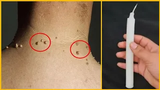 بشمعة واحدة فقط تخلصي من الثآليل  ستتختفي وتموت للأبد / علاج الزوائد الجلدية