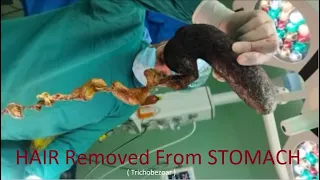 Patient Was in Habit Of Eating Hairs  Surgically Removed