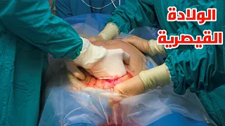 شاهد كيف تتم عمليه الولاده القيصريه لأول مره بحياتك_Watch the caesarean section step by step