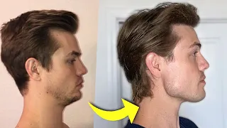 My Chin Used to Be Recessed—Here’s How I Fixed It