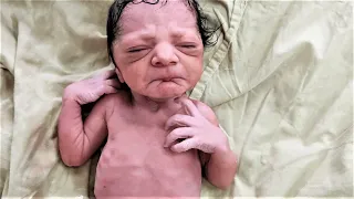 Old looking Newborn BABY | IUGR vs. Progeria