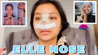 I GOT A NOSE JOB (RHINOPLASTY) | ELLE QUIÑONES