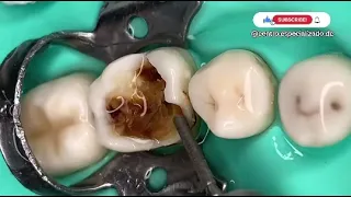 ¡🔥IMPRESIONANTE la profundidad de la caries en una muela llegamos hasta el nervio 🔥!