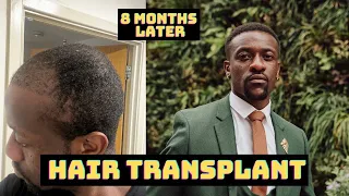 HAIR TRANSPLANT results after 8 months | Before & After | Daniel Asante
