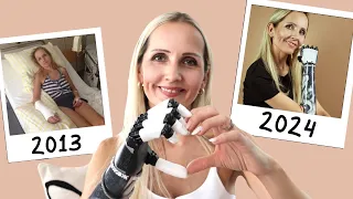 Von der Amputation zu 1M Followern: Meine unglaubliche Reise 🌟