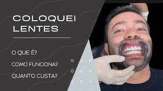 Maromba pode usar Lentes de Contato Dental?