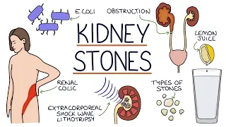 Understanding Kidney Stones