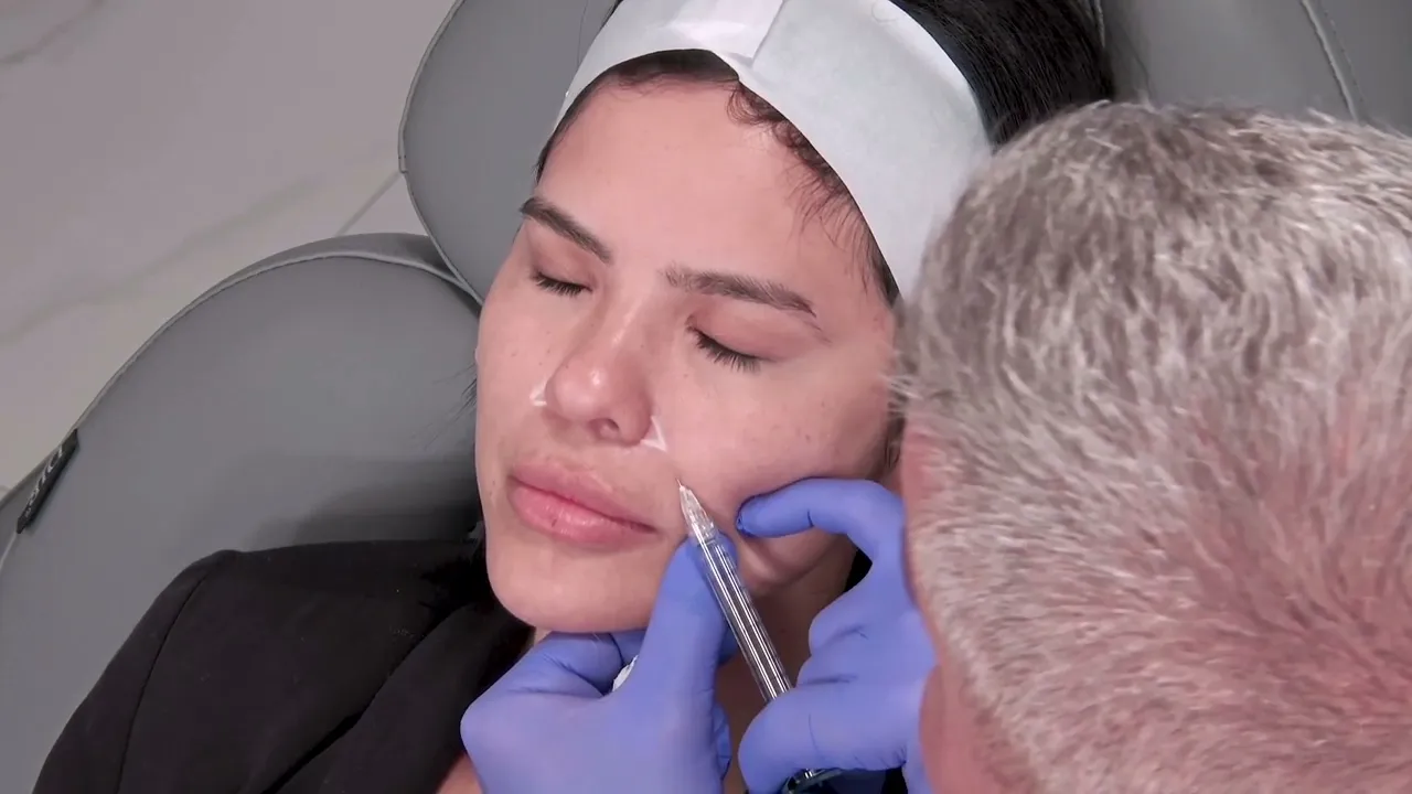 Dermal Filler Nasolabial Fold Treatment video