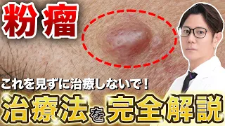 粉瘤ができる原因と治療方法を現役皮膚科医が徹底解説