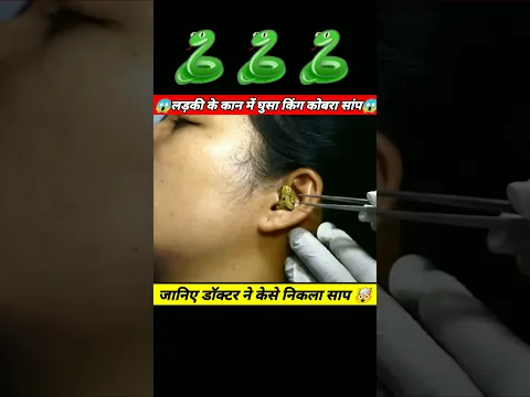 🐍 क्या हुआ जब लड़की के कान मैं घुसा किंग कोबरा साँप ☠️#shorts #shortvideo #trending