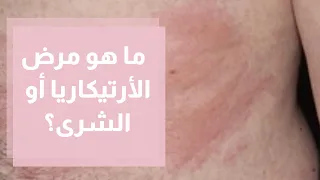 ما هو مرض الأرتيكاريا أو الشرى؟