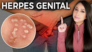¿Por qué el HERPES no tiene cura? l Herpes genital: Causa, síntomas y TRATAMIENTO👩🏻‍⚕️ @drapauzuniga