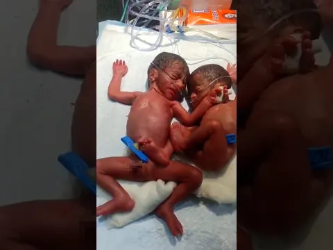 Twins cute caring babies #junior #baby #birth #premature #adorable #newbornbaby #shorts