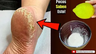 Receta casera para eliminar talones agrietados de los Pies Secos y con Grietas