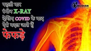 पहली बार रंगीन X-Ray, देखिए Covid के बाद ऐसे बदल जाते हैं फेफड़े