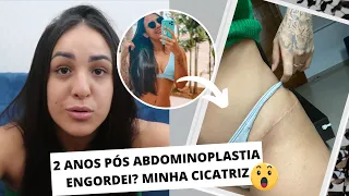 2 ANOS PÓS ABDOMINOPLASTIA COM LIPO | MOSTREI A CICATRIZ, EU ENGORDEI? ME ARREPENDI DE TER FEITO?