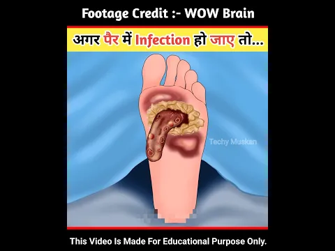 अगर पैर में Infection हो जाए तो... #asmr #viral