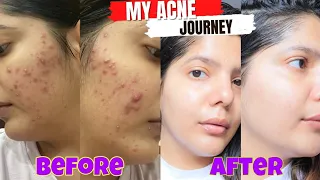 My acne journey that changes my life | How i cleared my skin in 4 months
