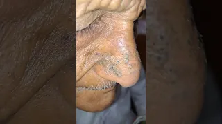 Nose & Scalp cleaning off