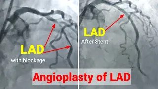 Angioplasty ll Angioplasty procedure(Radial access),  Stenting of LAD, हार्ट मैं छल्ला कैसे लगाते है