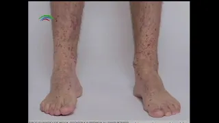 Mitos de la Salud: Púrpura de Henoch-Schönlein.