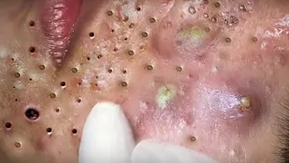 ニョキニョキ角栓/スポスポ角栓除去/𝐫𝐞𝐥𝐚𝐱/𝐒𝐚𝐭𝐢𝐬𝐟𝐲𝐢𝐧𝐠/𝐧𝐨𝐬𝐞 𝐛𝐥𝐚𝐜𝐤𝐡𝐞𝐚𝐝𝐬/𝐭𝐰𝐞𝐞𝐳𝐞𝐫𝐬/𝐚𝐜𝐧𝐞 𝐭𝐫𝐞𝐚𝐭𝐦𝐞𝐧𝐭/ピンセット/피지제거𝐍𝐨.35