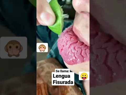 Lengua Fisurada 👅 #shorts