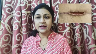 post cesarean care सीज़र ऑपेरशन डिलीवरी के बाद केअर sezar सिजेरियन टांकों टांकें स्टिच देखभाल