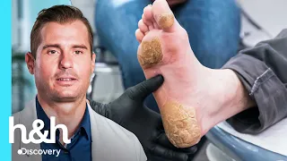 Dr. Brad: "Nunca vi callosidades como éstas" | Mis pies me están matando | Discovery H&H