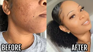 I Got Clear Skin Doing This For One Week + Video Proof | Acne & Scars Skin Care Routine | Glass Skin