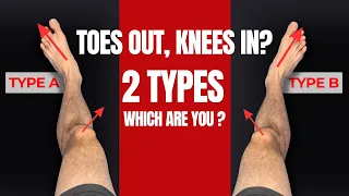 Before You Force Your Feet Straight, Watch This
