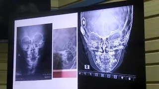 Cochlear Implantation 4 Dr Usama Abdulnaseer