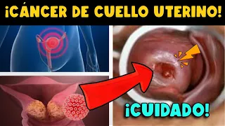 ¡CUIDADO! SI SIENTES ESTO PUEDES TENER CÁNCER DE CUELLO UTERINO - AHORA ES MÁS COMÚN EN JÓVENES
