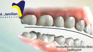 Correction of Deep Bite Using the Reverse Curve of Spee in the Lower Jaw