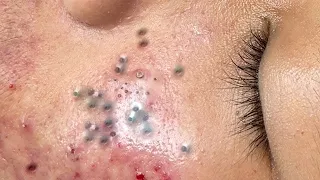Blackheads Removal at Skin Fix Pro #218