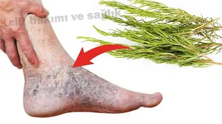 İnanılmaz! Biberiye ile varisli damarları ortadan kaldırın. Her evde olması gereken bir hazine!