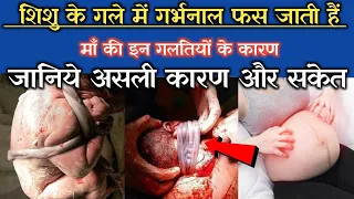 गर्भ में बच्चे के गले में गर्भनाल क्यों लिपट जाती है (7-8-9)वें महीने में जाने कारण Cord Around Neck