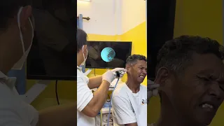 👀 Don’t Blink—The Final Extraction Is Incredible! #earwaxremoval #ent #shorts
