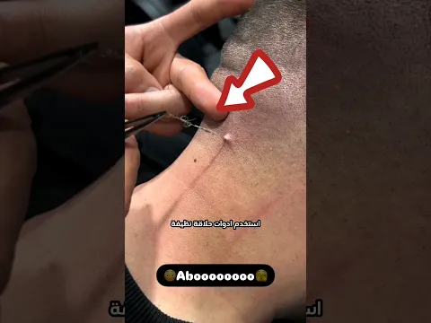 كيف تحمي نفسك من نمو كيس الشعر؟ 🤔