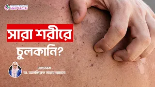 পুরো শরীরে চুলকানী | চুলকানি থেকে মুক্তির উপায় | চুলকানি হলে কি করনীয় | #itchingproblem