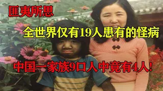 匪夷所思!全世界仅有19人患有的怪病,中国一家族9口人中竟有4人! #真相