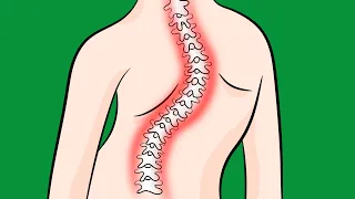How to Fix Idiopathic Scoliosis Naturally
