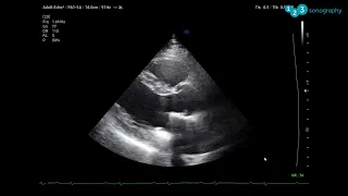 Demonstration: What type of prosthetic valve is this?