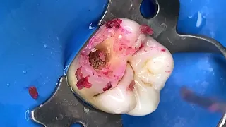 🔥EL TINTE ROJO es para detectar CARIES en las muelas 🔴🦷🔥