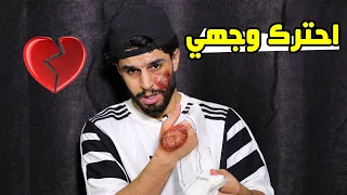 قصة حرق وجهي ؟!❤️‍🩹 #عمار ماهر