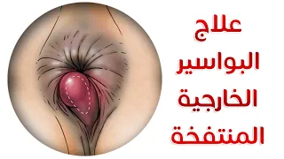علاج البواسير الخارجية المنتفخة.. بسرعة و ضمان !