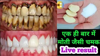 पीले दांतो को सफेद करने का अनोखा तरीका आज तक नहीं देखा होगा | Teeth cleaning only 5 minutes