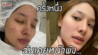 Ep.1 หน้าพัง สิวบุกหน้ามันเยิ้ม|รักษาผิดวิธี|สาเหตุ(มีรูปขึ้นให้ดูจุกๆ) | widpim withpim