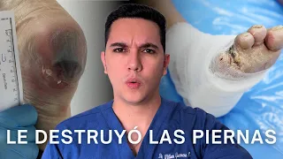 De una simple herida a una amputación, el peligro oculto de la diabetes | Dr. William Guerrero